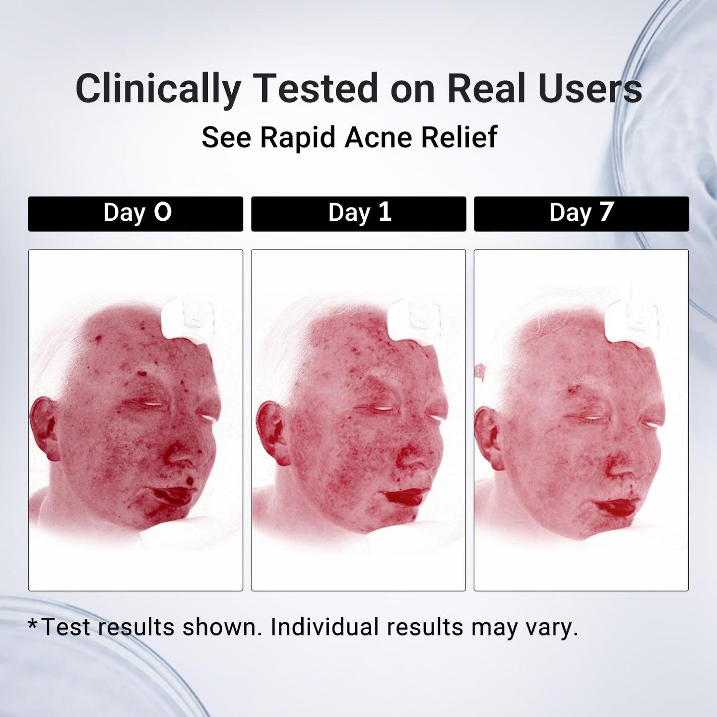 Dr.Leo Drying Lotion | Pimple Treatment & Body Acne Treatment | Visibly Shrinks Pimples in 24 Hours & Helps Fade Acne Marks in 7 Days | With 1.8% Encapsulated Salicylic Acid, 4% Niacinamide & 10% Sulfur (20ml) #mothersdaygift #Summervibes
