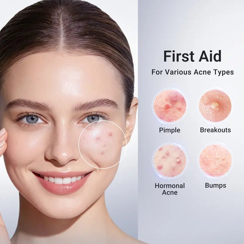 Dr.Leo Drying Lotion | Pimple Treatment & Body Acne Treatment | Visibly Shrinks Pimples in 24 Hours & Helps Fade Acne Marks in 7 Days | With 1.8% Encapsulated Salicylic Acid, 4% Niacinamide & 10% Sulfur (20ml) #mothersdaygift #Summervibes